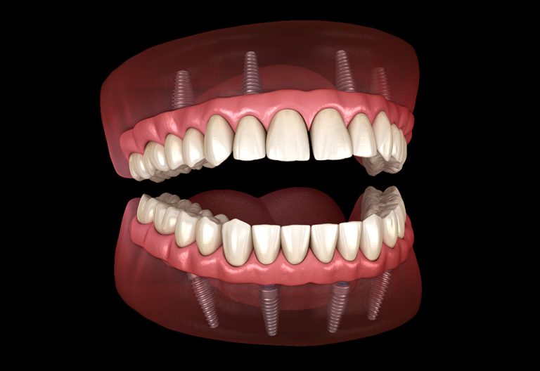 NaturalLooking AllonFour Dentures Coastal Periodontics
