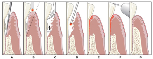 LANAPchart_visual LANAP chart