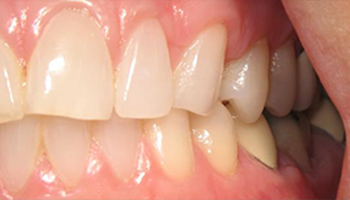 gum recession after treatment image