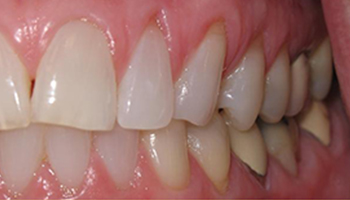 gum recession before image