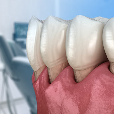 Coastal_BlogLP_398x398_GumRecession prevent gum recession