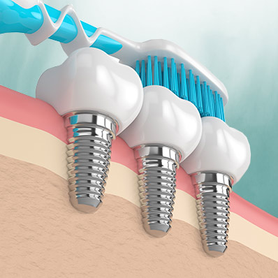 how to clean all on four dental implants