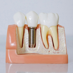 Coastal_BlogImage_252x252_Which Dental Implant Procedure Is Right for You